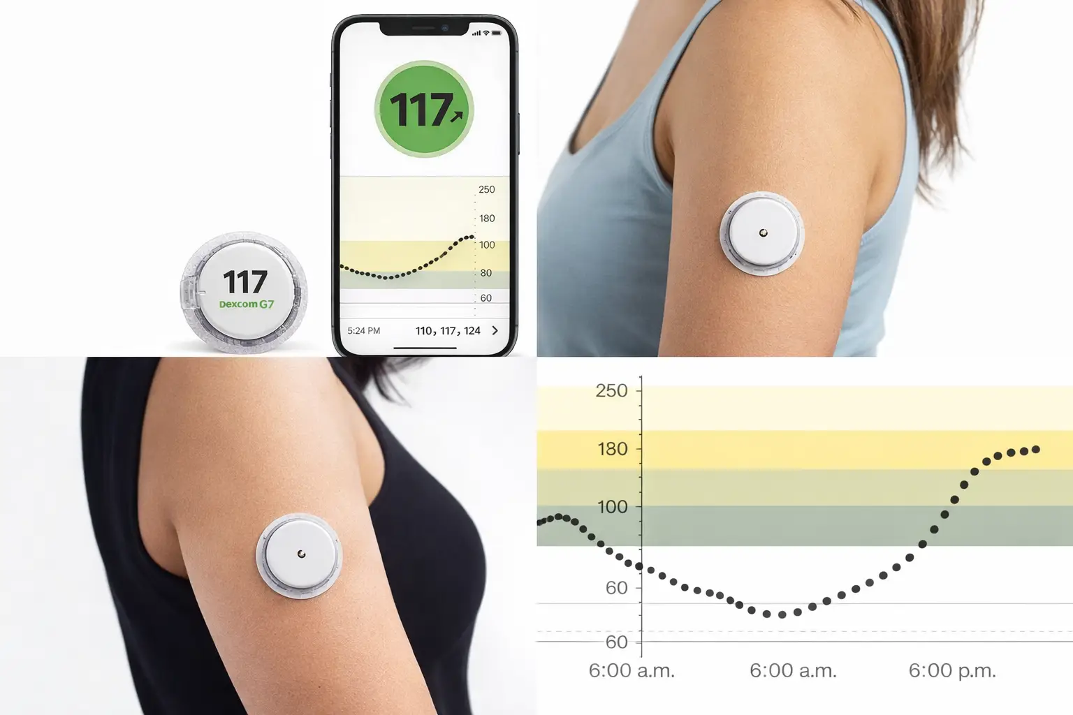 Monitores continuos de glucosa (MCG): cómo funcionan, diferencias entre Dexcom, FreeStyle Libre, Medtronic y Eversense, precisión, cuándo confirmar con glucosa capilar y guía completa de uso